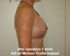 plastic-surgery-breast-augmentation